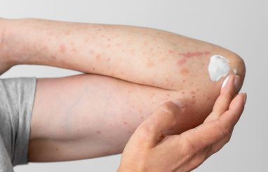 Jakie są najczęstsze objawy atopowego zapalenia skóry i jak sobie z nimi radzić?